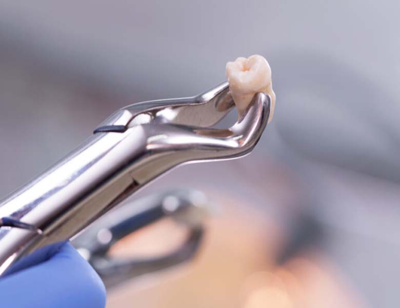 下松市（山口県）の歯医者、たけなわ歯科口腔外科クリニックの歯を失う原因