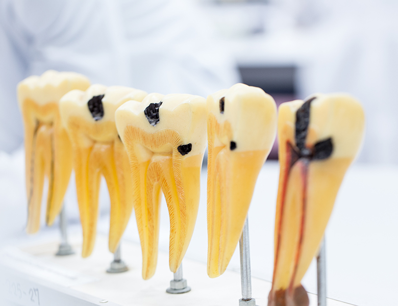 下松市(山口県)の歯医者、たけなわ歯科口腔外科クリニックのむし歯治療