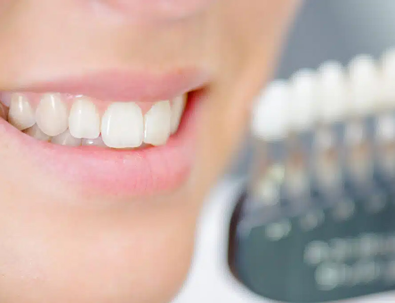 下松市(山口県)の歯医者、たけなわ歯科口腔外科クリニックのホワイトニング