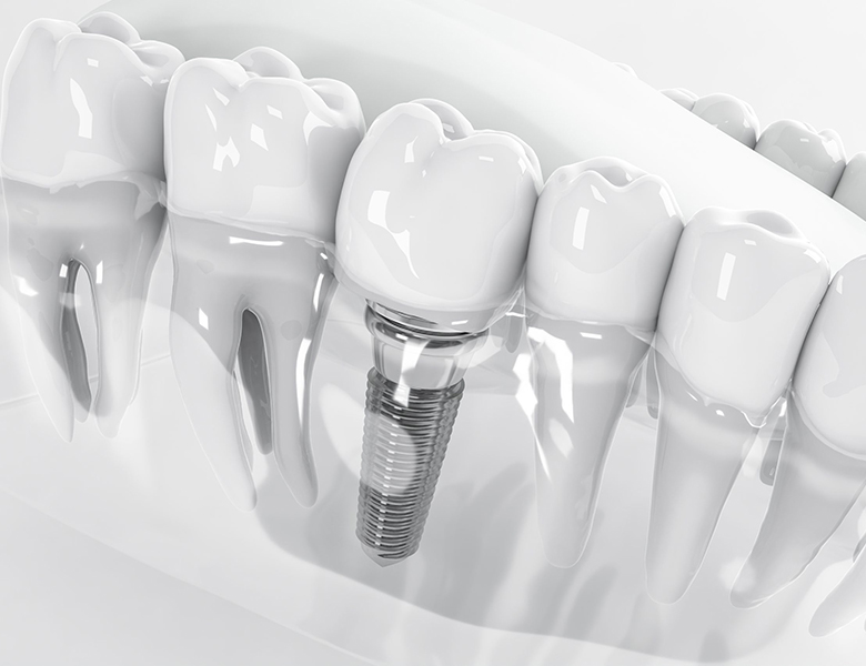 下松市（山口県）の歯医者、たけなわ歯科口腔外科クリニックのインプラント