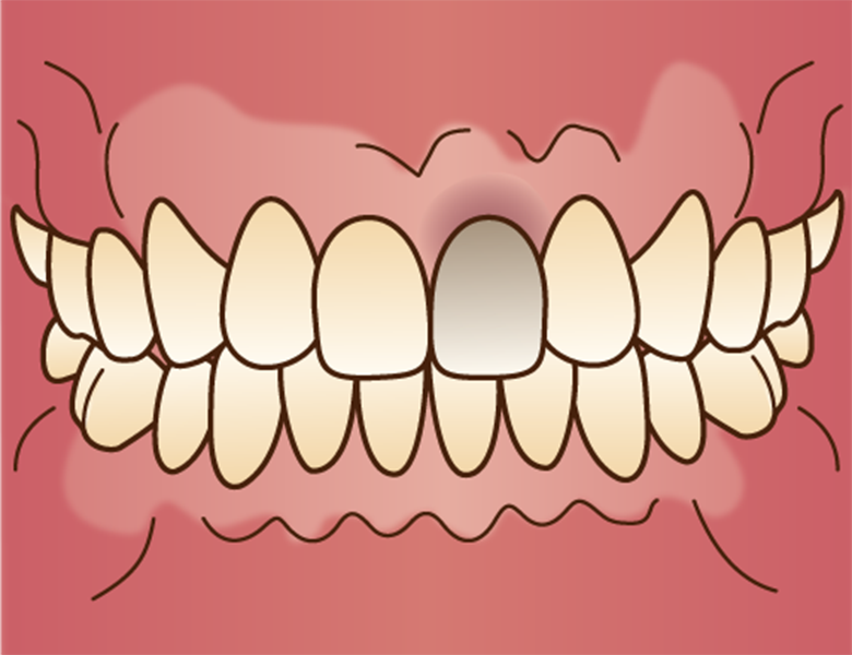 下松市（山口県）の歯医者、たけなわ歯科口腔外科クリニックのホワイトニング