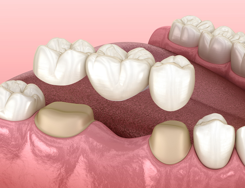 下松市（山口県）の歯医者、たけなわ歯科口腔外科クリニックのブリッジ