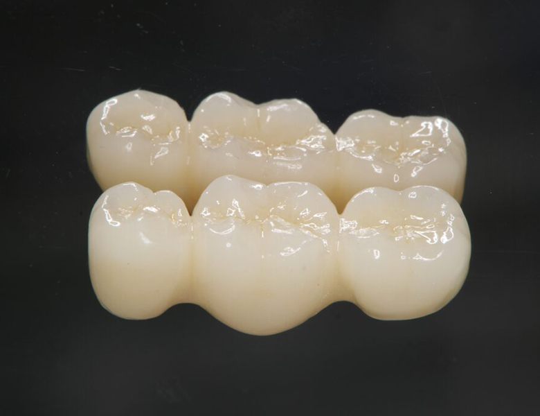 下松市（山口県）の歯医者、たけなわ歯科口腔外科クリニックのブリッジ