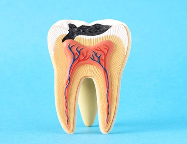 下松市（山口県）の歯医者、たけなわ歯科口腔外科クリニックのむし歯（う蝕）治療