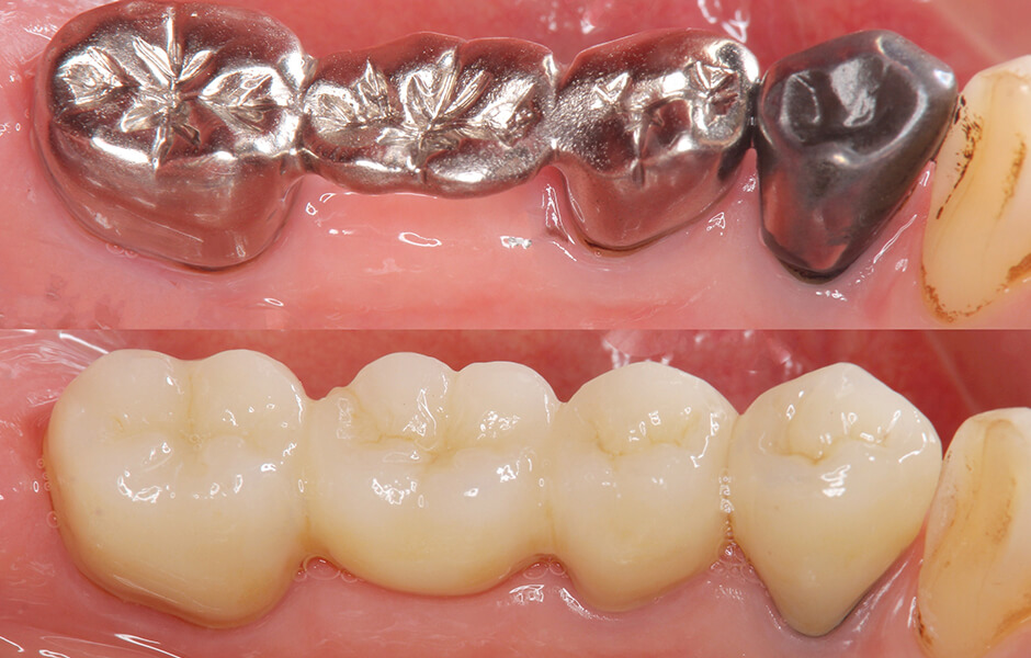 下松市（山口県）の歯医者、たけなわ歯科口腔外科クリニックのブリッジ