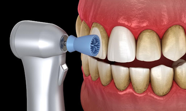 下松市（山口県）の歯医者、たけなわ歯科口腔外科クリニックのクリーニング