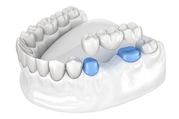 下松市（山口県）の歯医者、たけなわ歯科口腔外科クリニックのブリッジ
