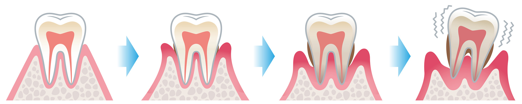 下松市（山口県）の歯医者、たけなわ歯科口腔外科クリニックの歯周病治療
