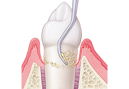 下松市（山口県）の歯医者、たけなわ歯科口腔外科クリニックの歯周外科