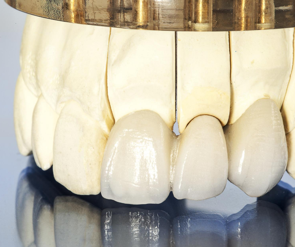 下松市（山口県）の歯医者、たけなわ歯科口腔外科クリニックのブリッジ