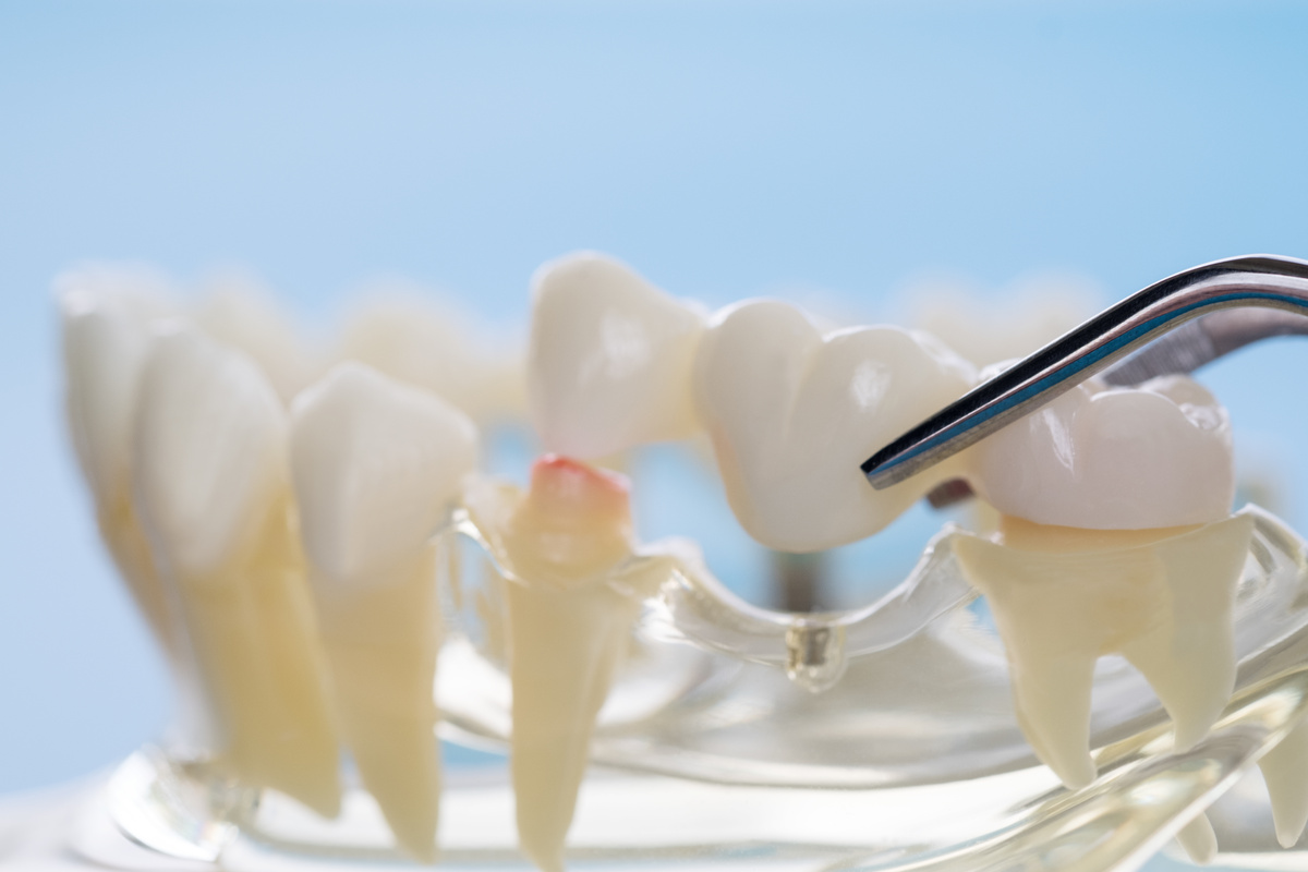 下松市（山口県）の歯医者、たけなわ歯科口腔外科クリニックのブリッジ